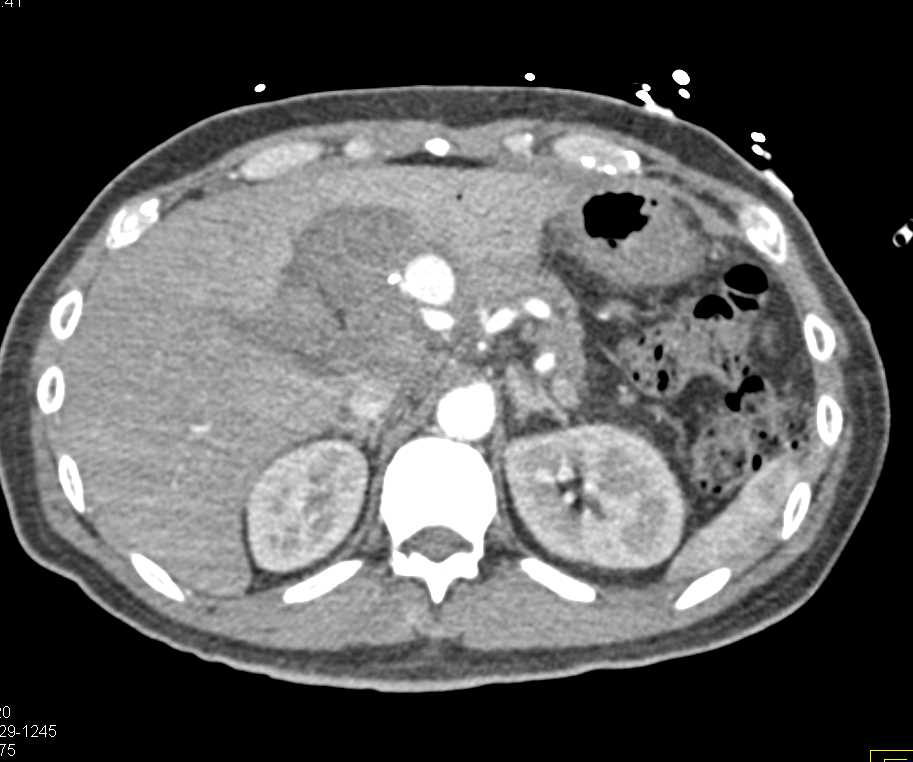 Hepatic Artery Aneurysm - CTisus CT Scan
