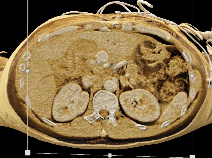 Hepatic Artery Aneurysm with CT Angiography and Cinematic Rendering - CTisus CT Scan