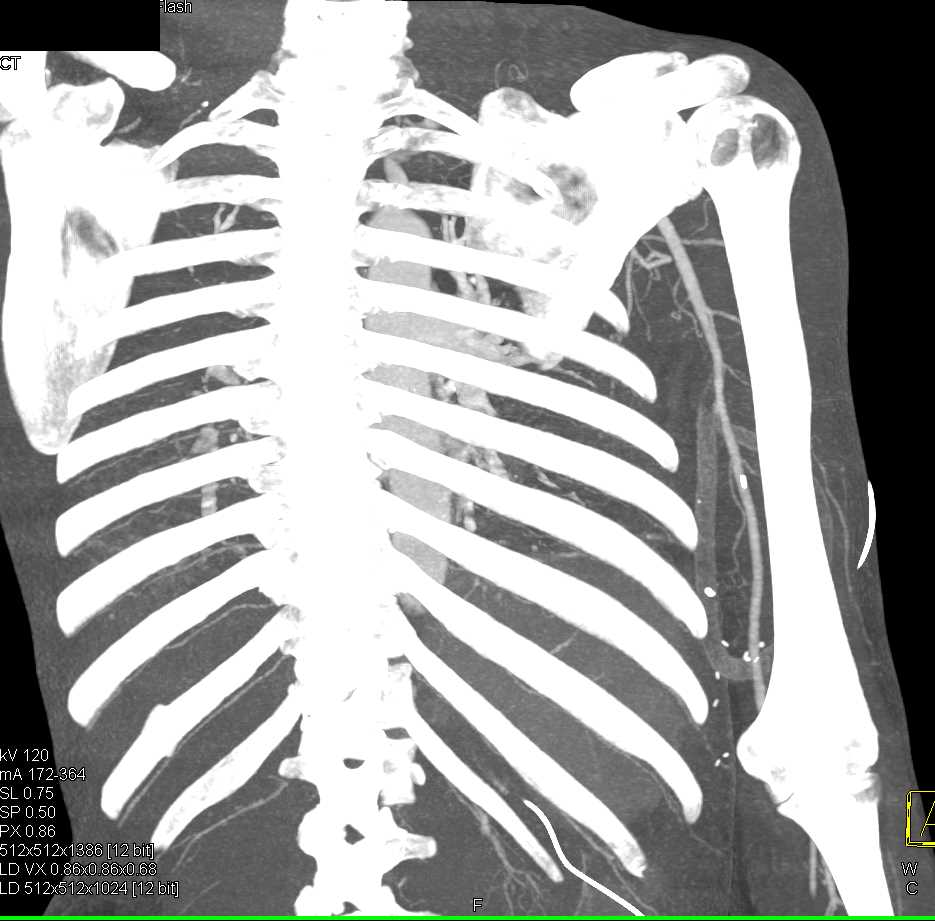 Trauma with Patent Brachial Artery - CTisus CT Scan
