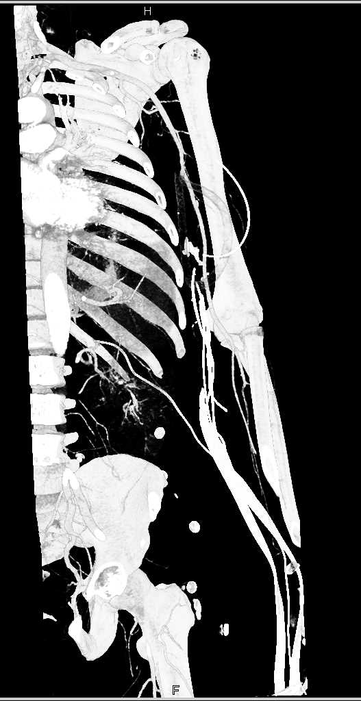 Trauma with Patent Brachial Artery - CTisus CT Scan