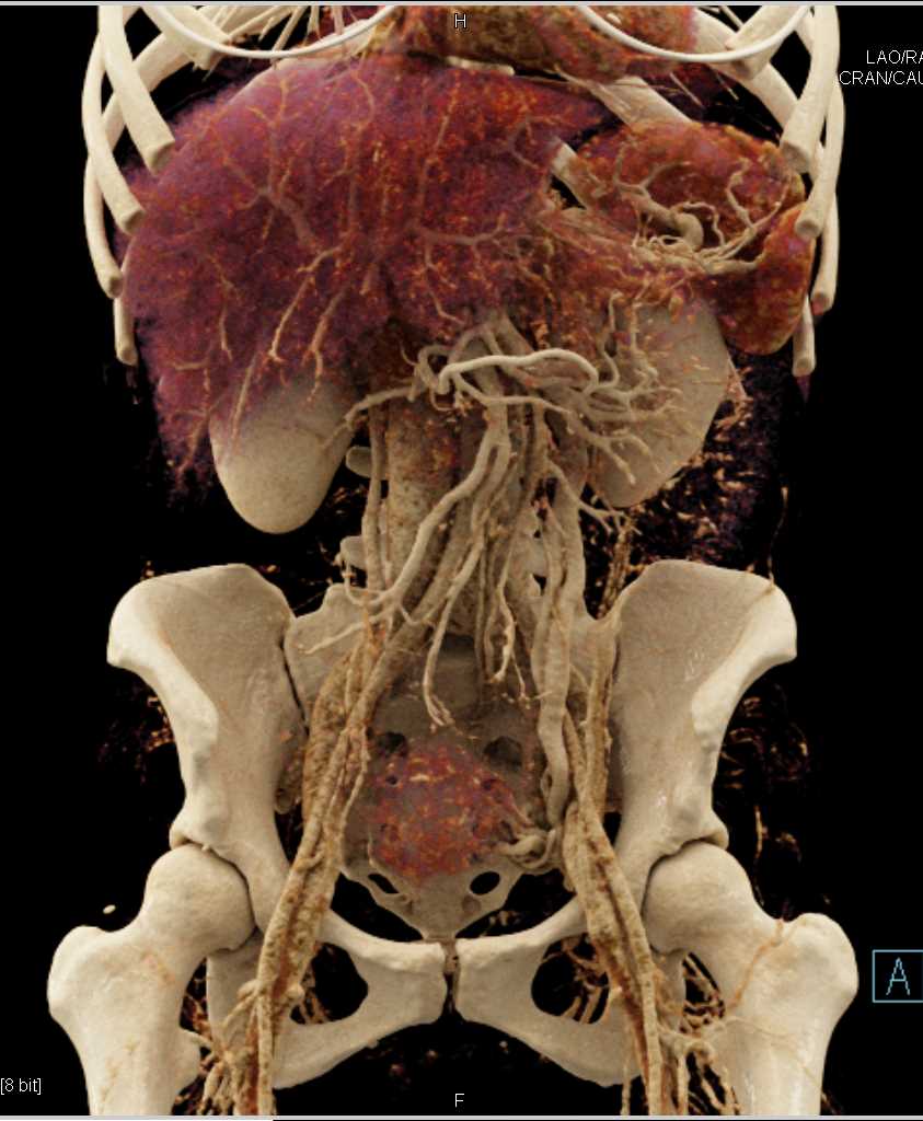 Prominent Left Pelvic Congestion Syndrome - CTisus CT Scan