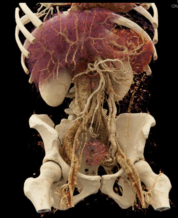 Prominent Gonadal Veins as Collaterals - CTisus CT Scan