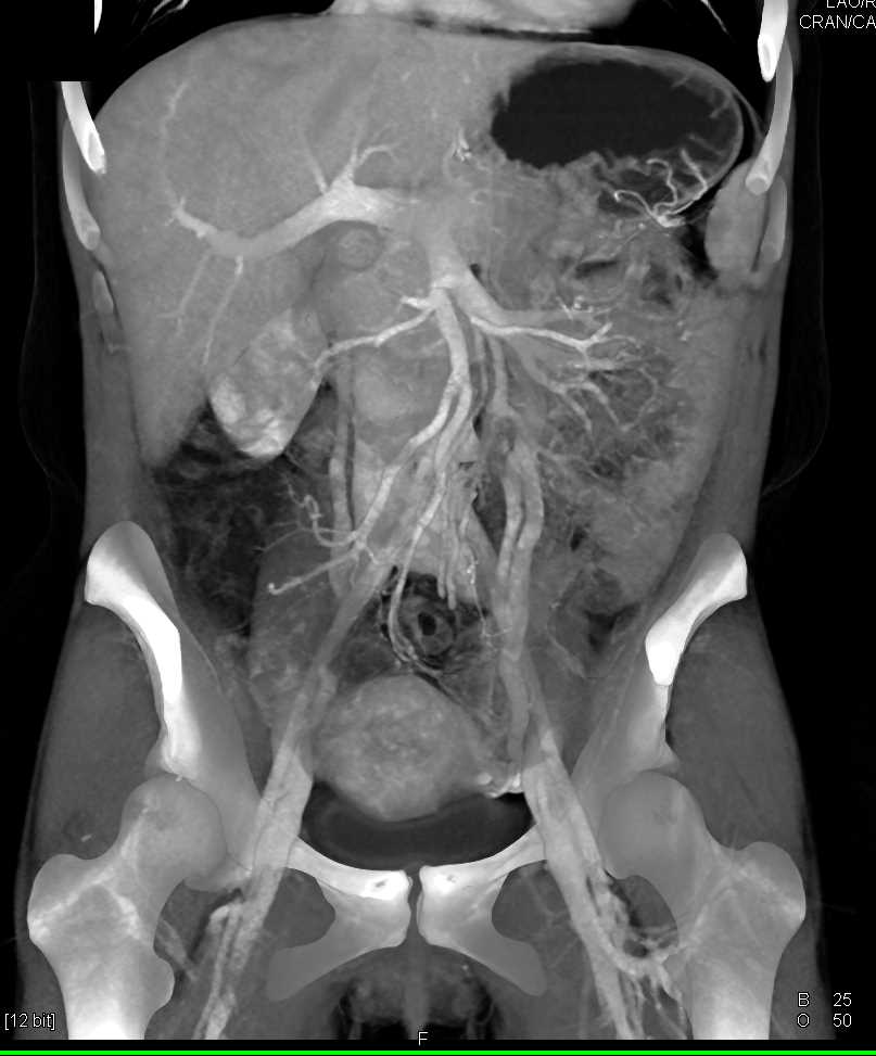 Prominent Gonadal Veins as Collaterals - CTisus CT Scan
