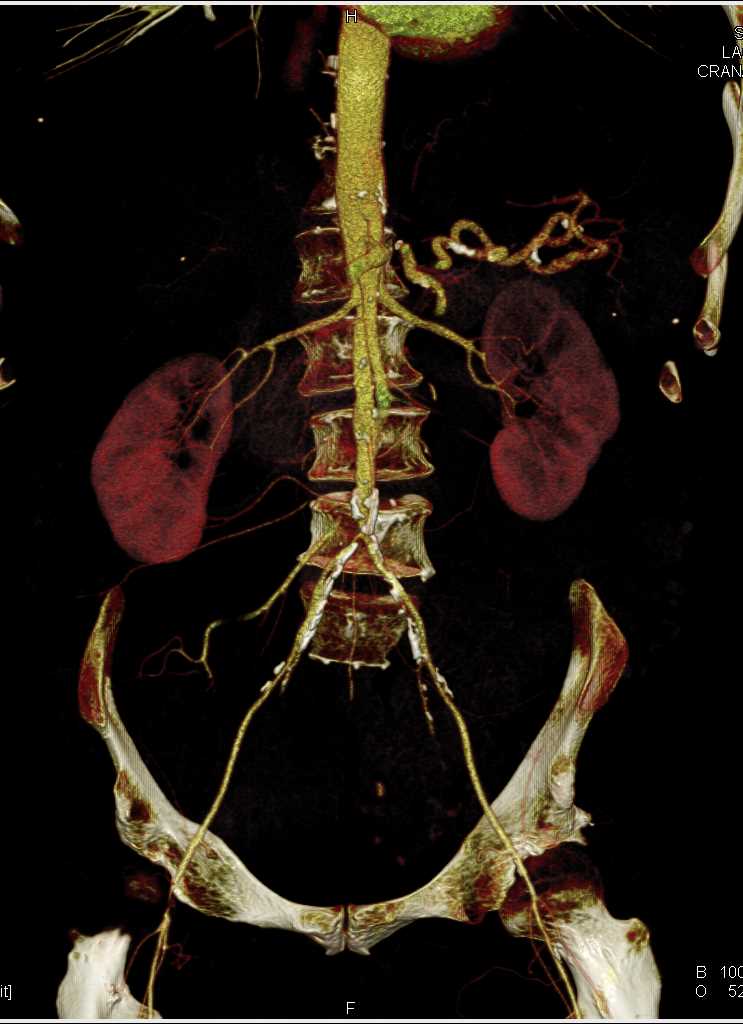 Diminished Caliber Iliac Arteries - CTisus CT Scan