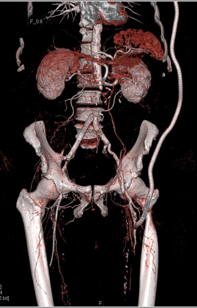 Occlusion of the Aorta - CTisus CT Scan