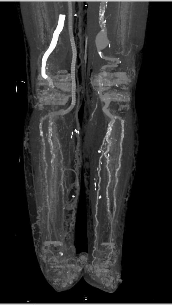 Peripheral Vascular Disease (PVD) with Vascular Grafts - CTisus CT Scan