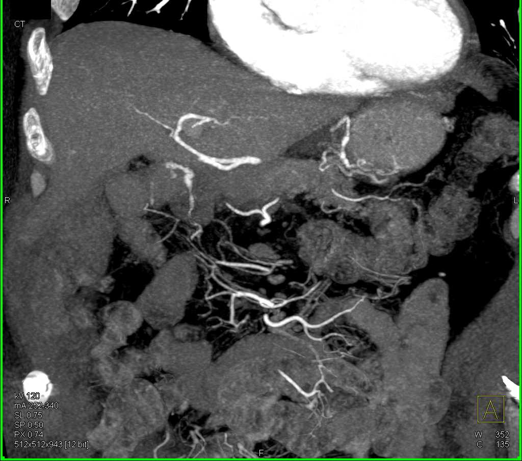 Irregular Gastroduodenal Artery (GDA) off Hepatic Artery - CTisus CT Scan