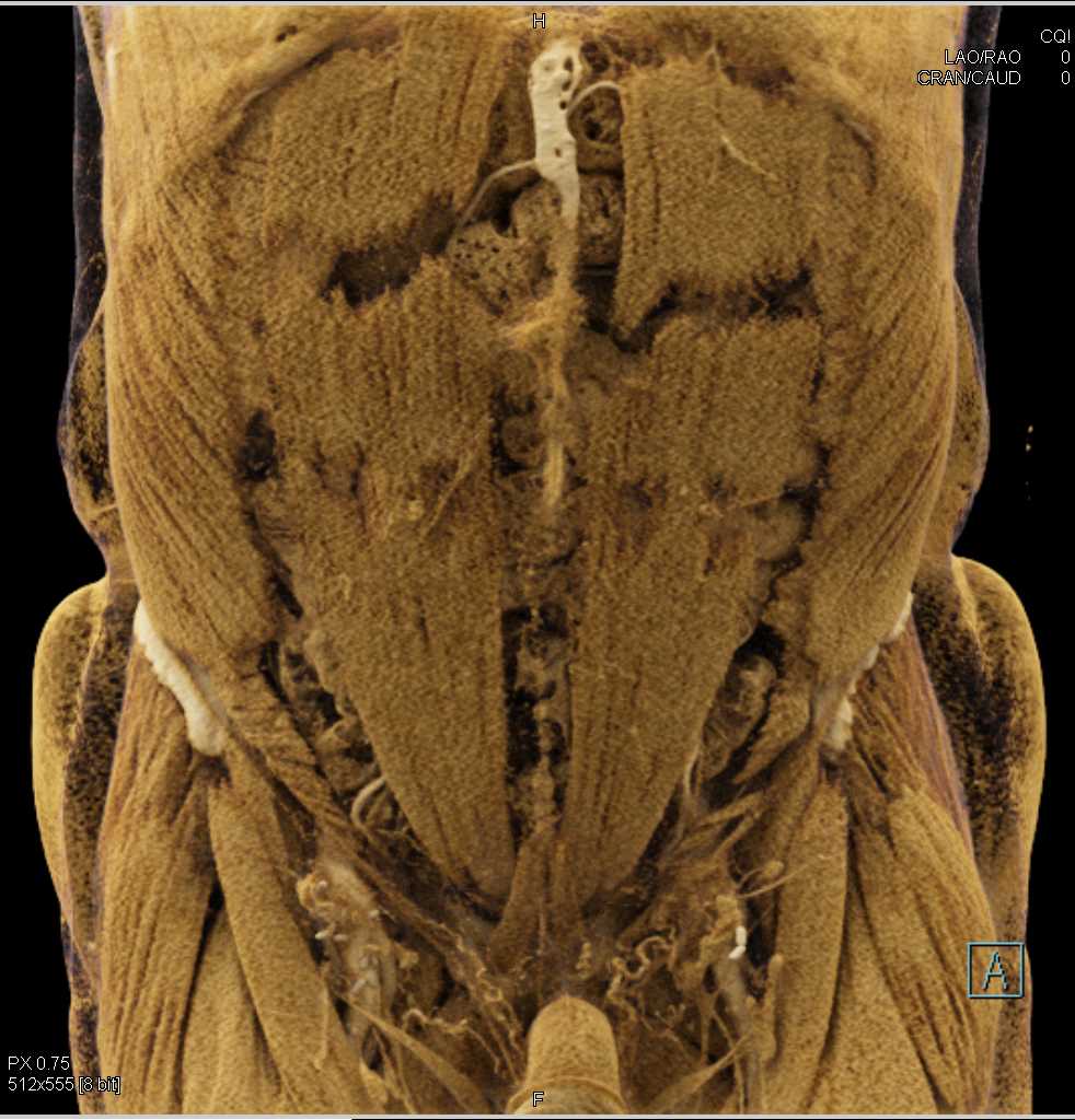 Vascular Grafts from Aorta to the Femoral Arteries - CTisus CT Scan