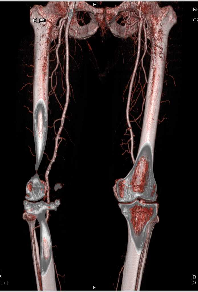 Occluded Left Common Iliac Artery - CTisus CT Scan