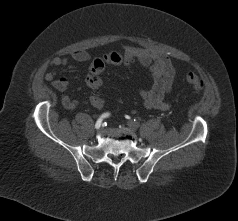 Occluded Left Common Iliac Artery - CTisus CT Scan