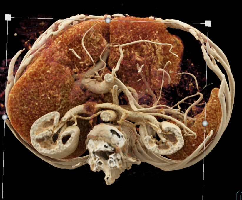 Cinematic Rendering of the Mesenteric Vascular Arcade - CTisus CT Scan