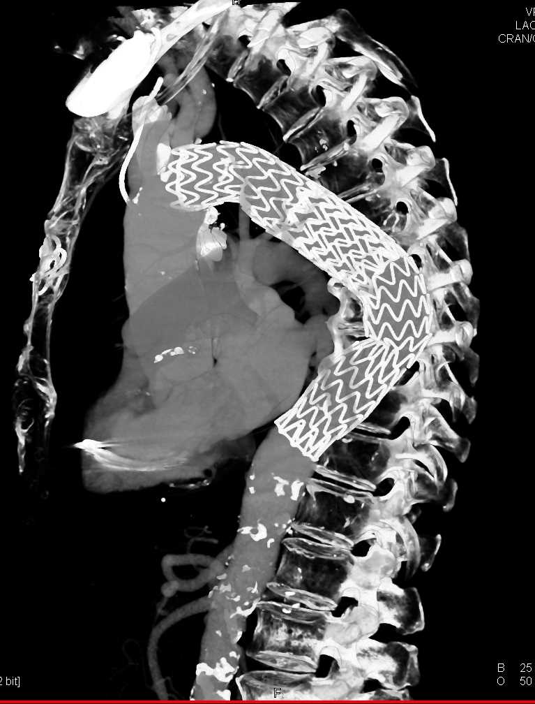 Endovascular Repair Descending Thoracic Aorta with Small Endoleak - CTisus CT Scan