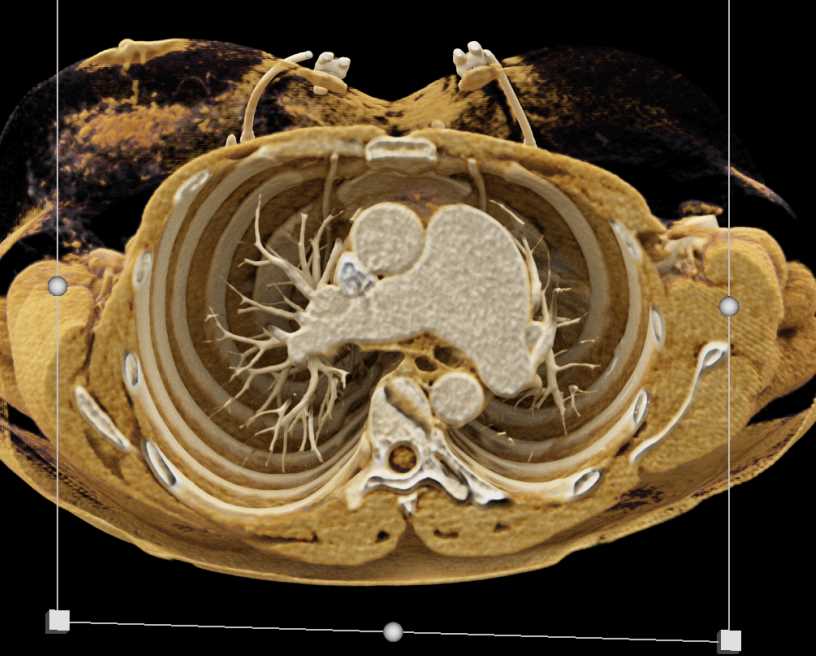 Dilated Main Pulmonary Artery with Cinematic Rendering - CTisus CT Scan