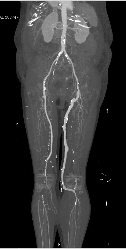 Graft from Superficial Femoral Artery (SFA) to Popliteal Artery - CTisus CT Scan