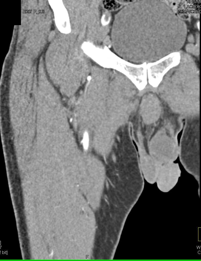 Occlusion of the Right Femoral Artery - CTisus CT Scan