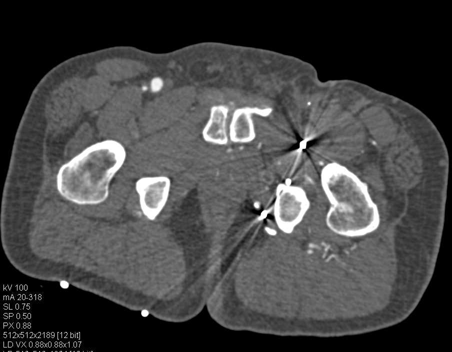 Gunshot Wound (GSW) with Superficial Femoral Artery (SFA) Occlusion - CTisus CT Scan