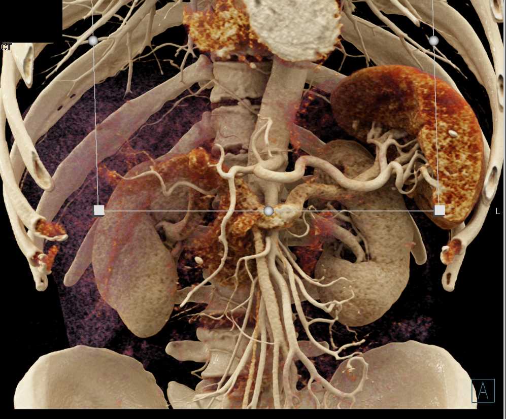 Vascular Mapping of the Superior Mesenteric Artery (SMA) and Celiac Artery - CTisus CT Scan