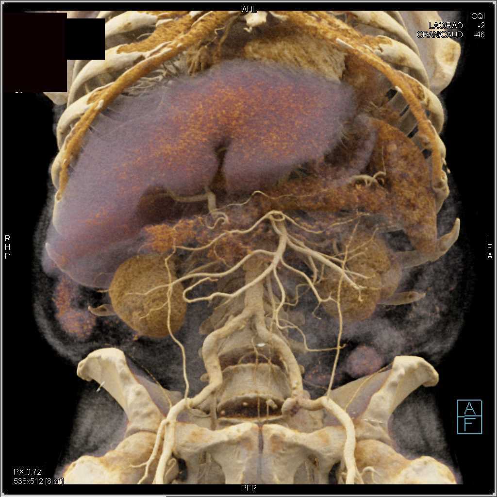 Erdheim Chester Disease Involves Aorta and Kidneys - CTisus CT Scan