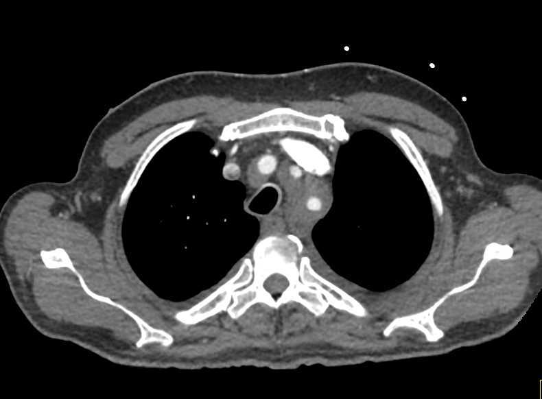 Erdheim Chester Disease Involves Aorta and Kidneys - CTisus CT Scan