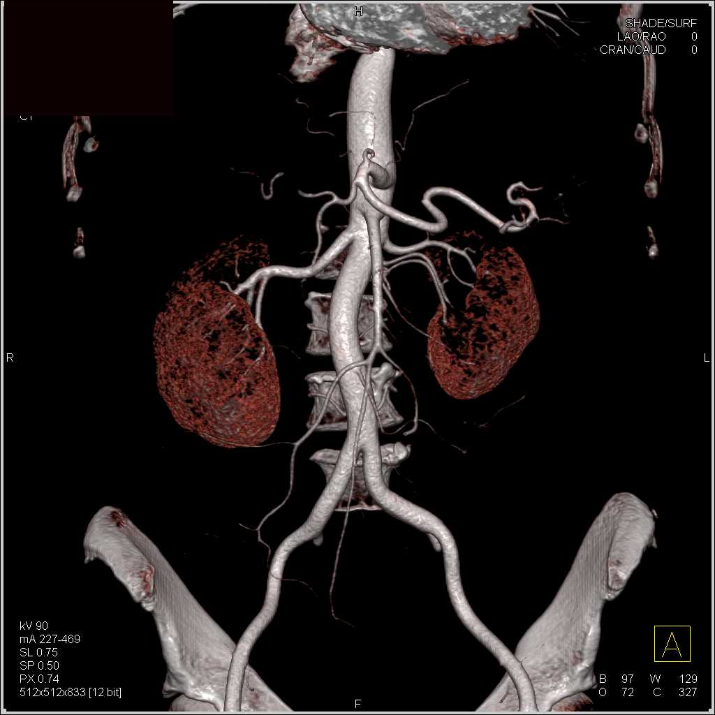 Superior Mesenteric Artery (SMA) and Celiac Anatomy - CTisus CT Scan