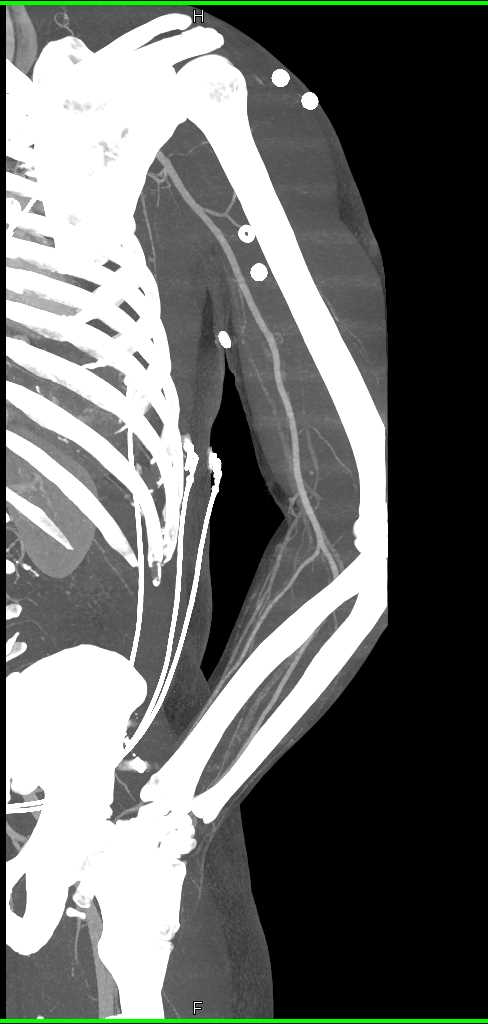 CTA Upper Extremity Without Vascular Injury - CTisus CT Scan