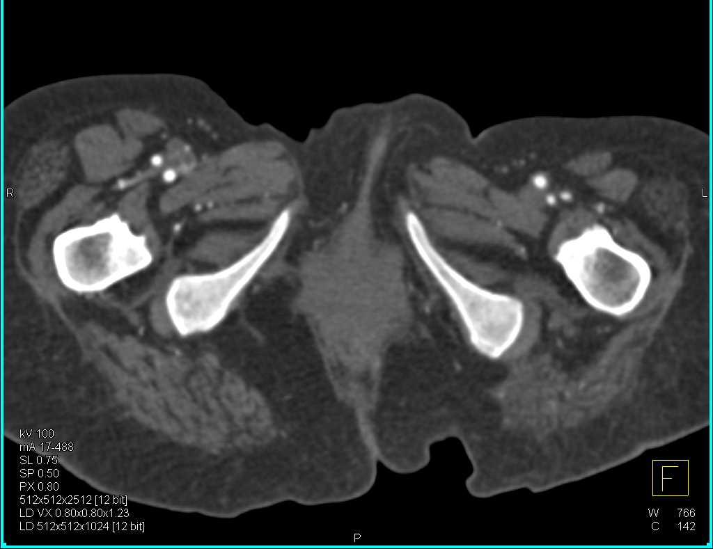 CTA with Peripheral Arterial Disease - CTisus CT Scan