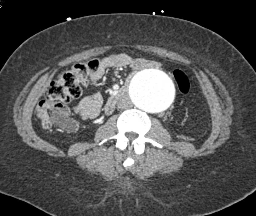 Enlarging Abdominal Aortic Aneurysm - CTisus CT Scan