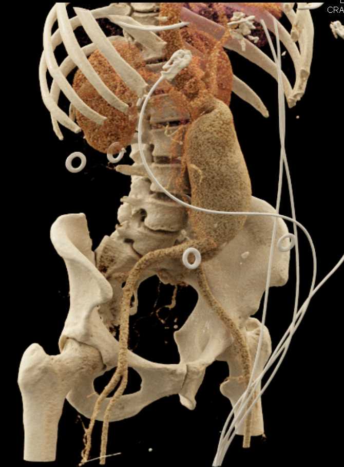 Enlarging Abdominal Aortic Aneurysm - CTisus CT Scan