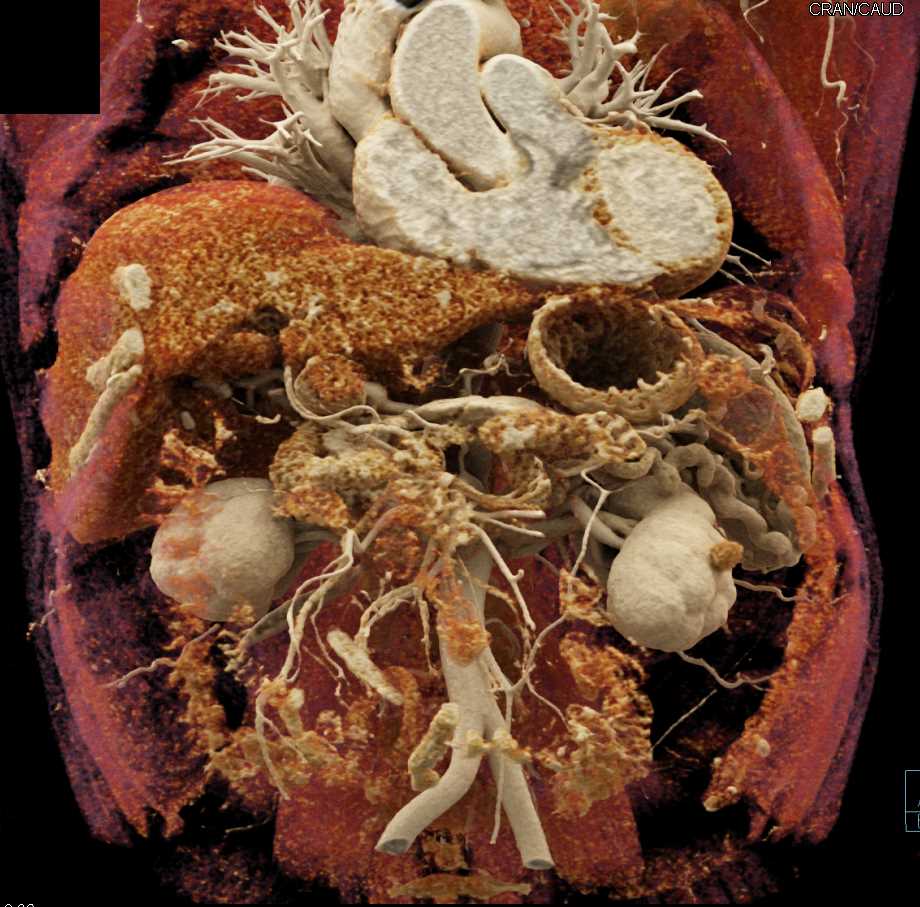 1cm Hepatic Artery Aneurysm - CTisus CT Scan