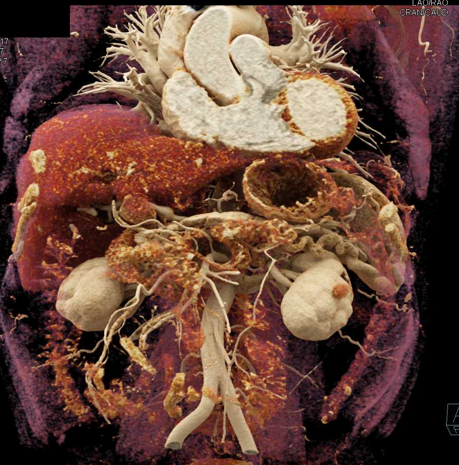 1cm Hepatic Artery Aneurysm - CTisus CT Scan