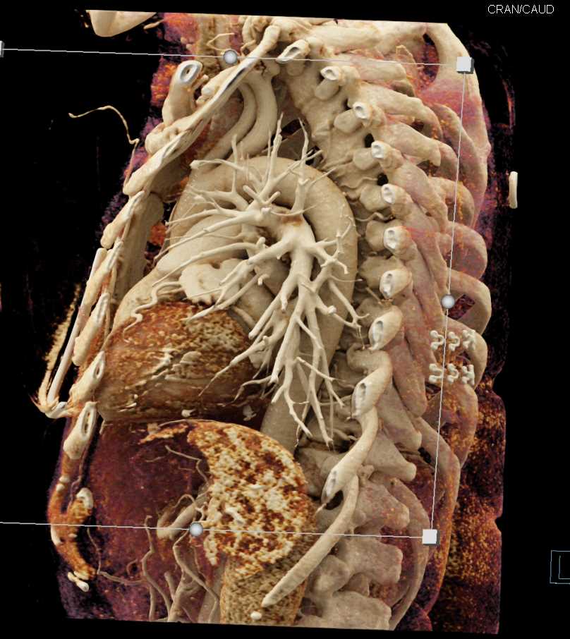 Vascular Mapping Thoracic Aorta - CTisus CT Scan