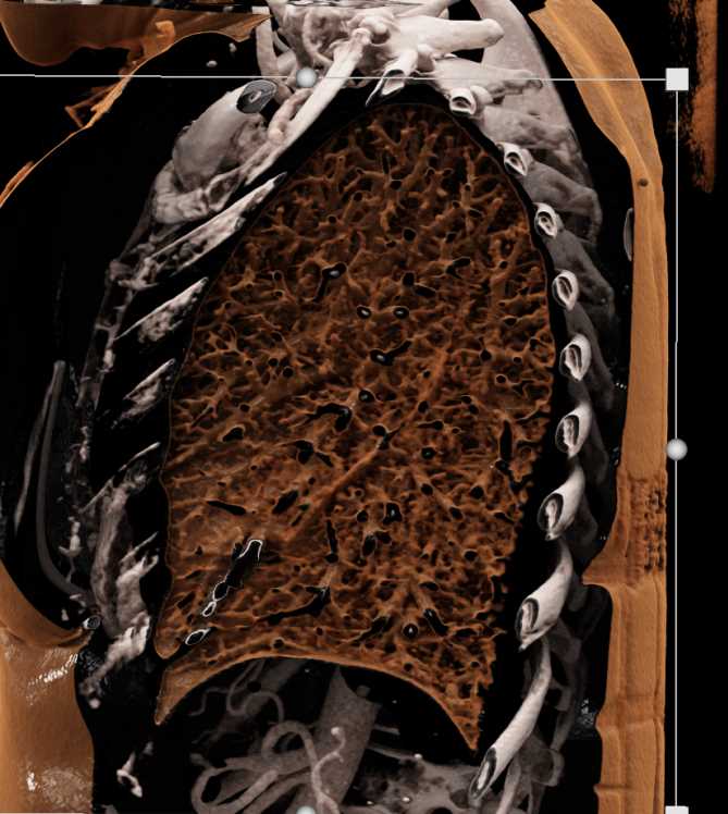 Vascular Mapping Thoracic Aorta - CTisus CT Scan