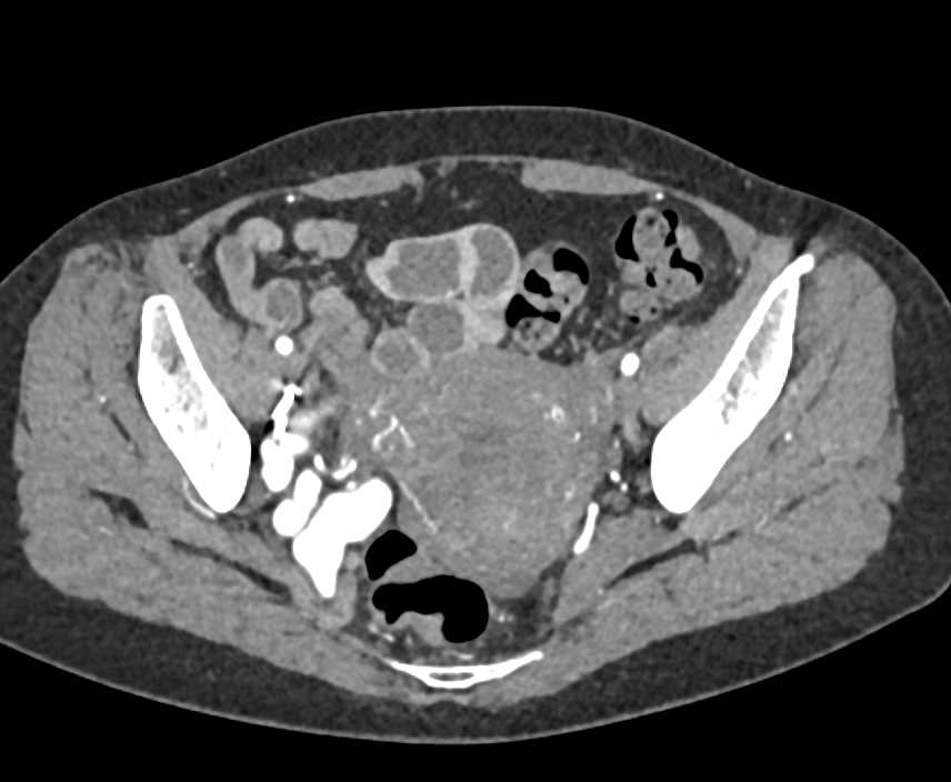 Coiling of Pelvic Arteriovenous Malformation (AVM) in Right Pelvic Sidewall - CTisus CT Scan