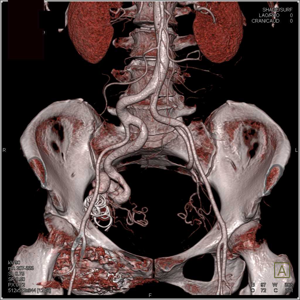 Coiling of Pelvic AVM in Right Pelvic Sidewall - CTisus CT Scan