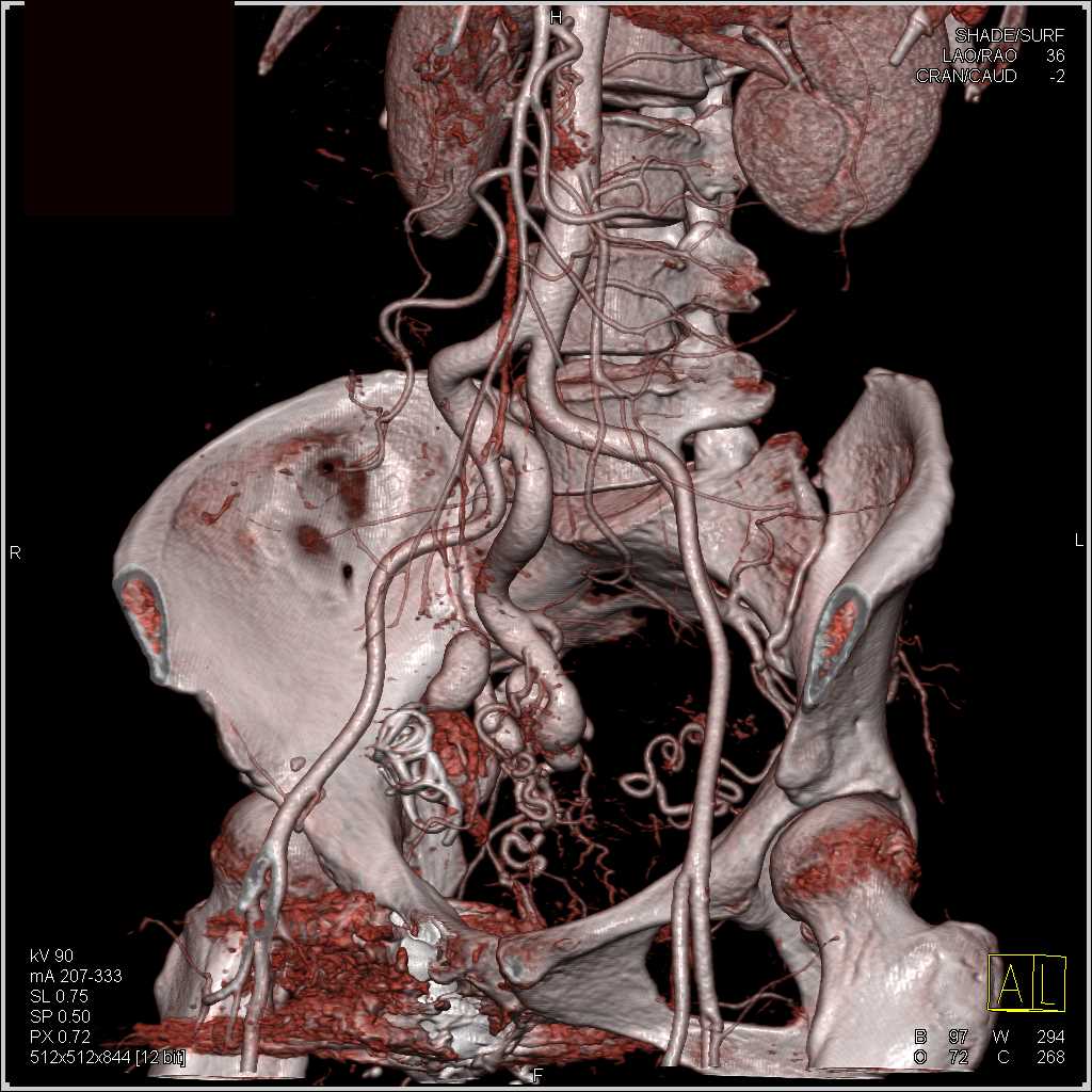 Coiling of Pelvic AVM in Right Pelvic Sidewall - CTisus CT Scan
