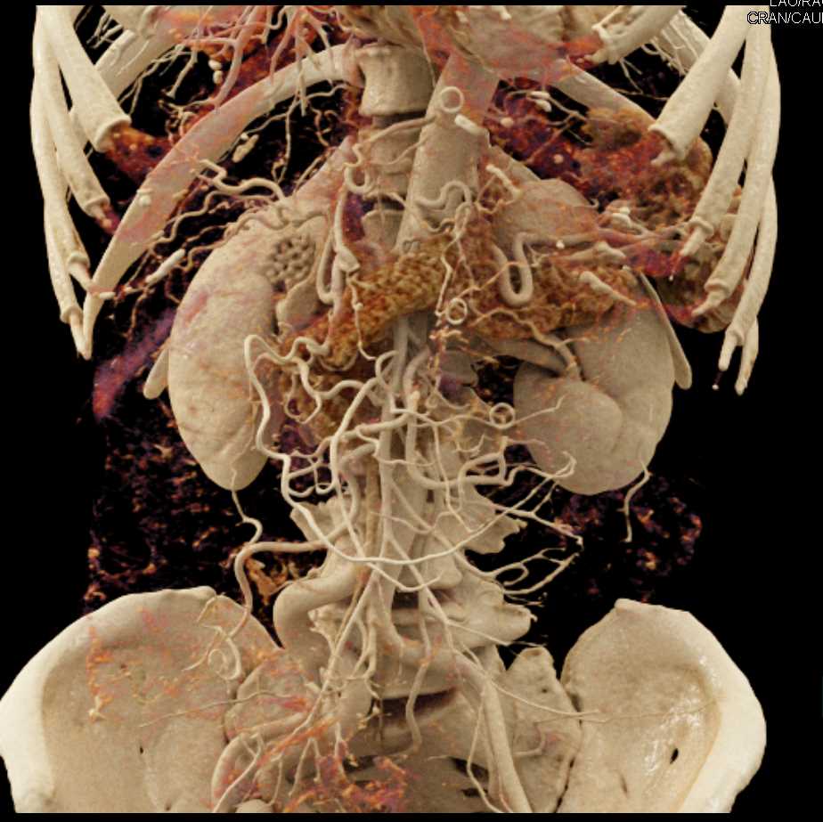 Coiling of Pelvic Arteriovenous Malformation (AVM) in Right Pelvic Sidewall - CTisus CT Scan