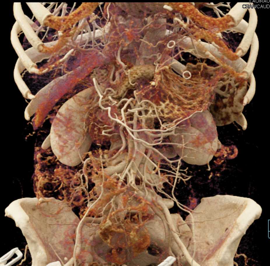 Mesenteric Vascular Mapping - CTisus CT Scan