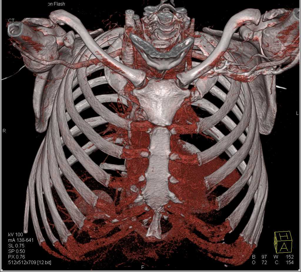 Vascular Mapping of Thoracic Syndrome on the Left Side - CTisus CT Scan