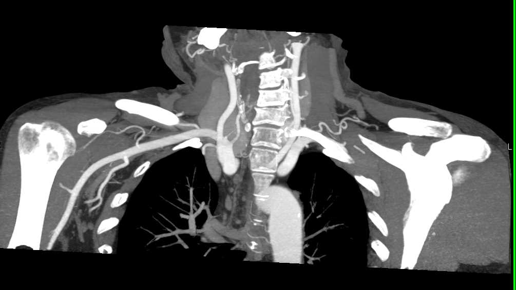 Vascular Mapping of Thoracic Syndrome on the Left Side - CTisus CT Scan