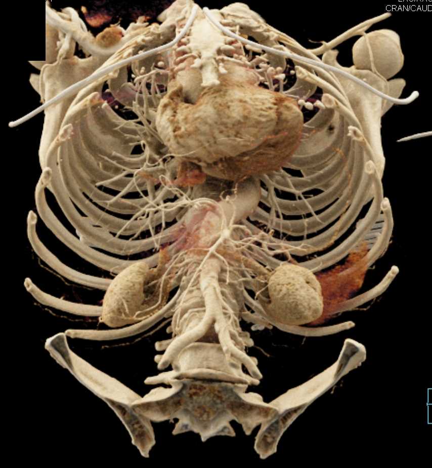 Mesenteric Vascular Arcade - CTisus CT Scan