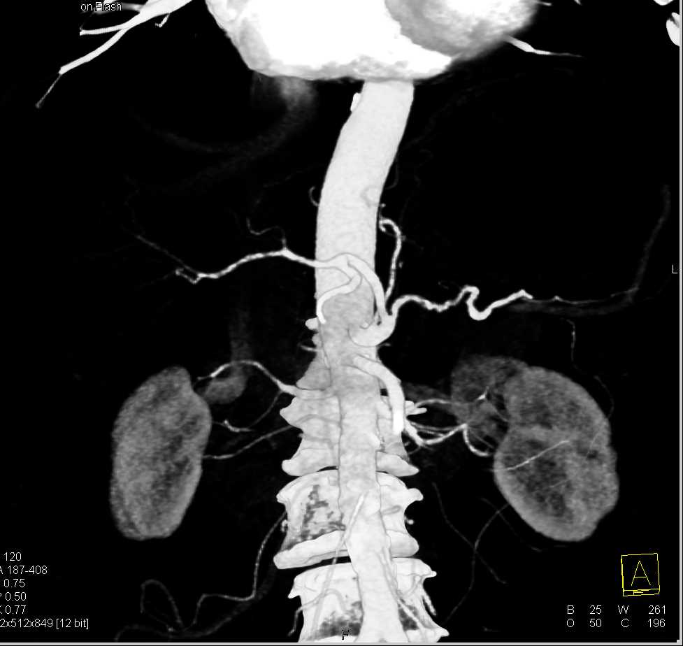 Vascular Disease in the Renal Arteries - CTisus CT Scan