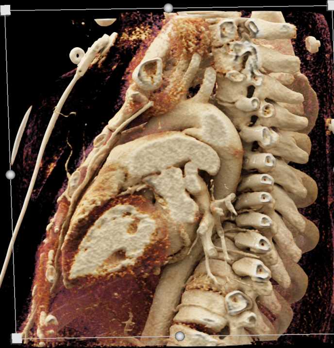 CTisus CT Scanning | Patent Ductus Arteriosus (PDA)