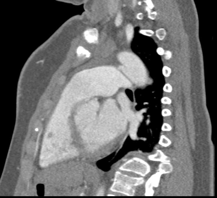 PDA (Patent Ductus Arteriosus) - CTisus CT Scan