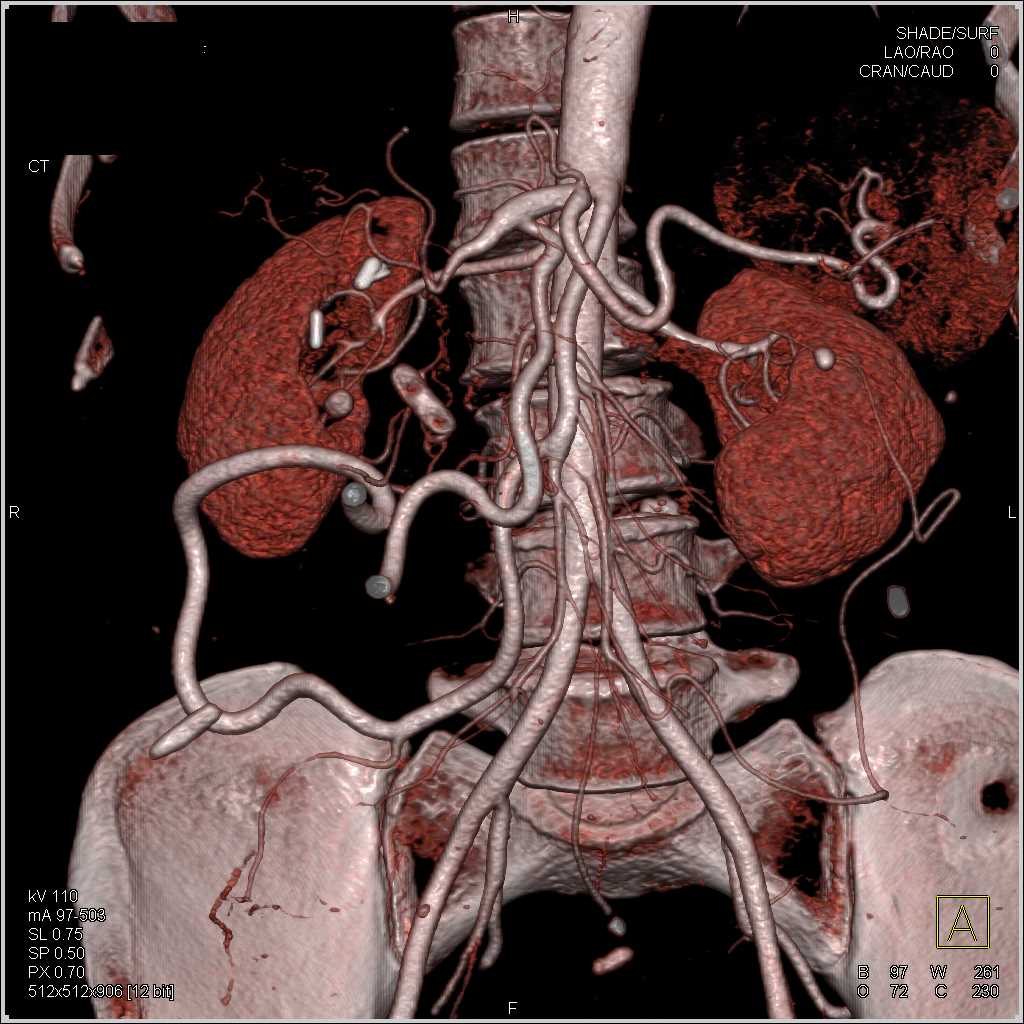 Celiac Occlusion with Dilated Gastroduodenal Artery (GDA) as Collateral Pathway - CTisus CT Scan