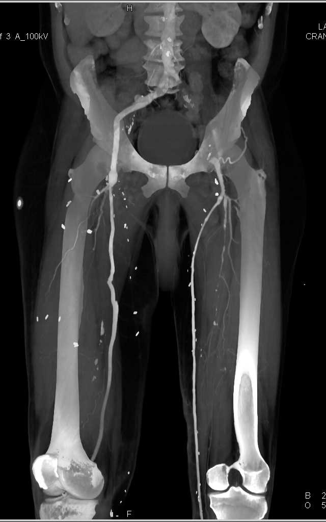 Multiple Bypass Grafts with MIP Imaging - CTisus CT Scan