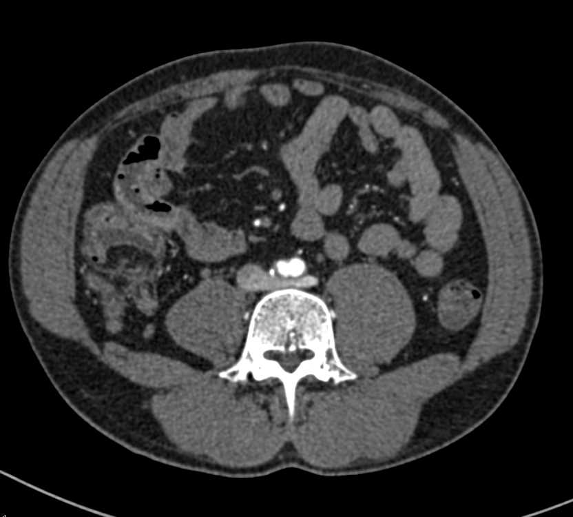 Vasculitis Involves Right Common Iliac Artery - CTisus CT Scan