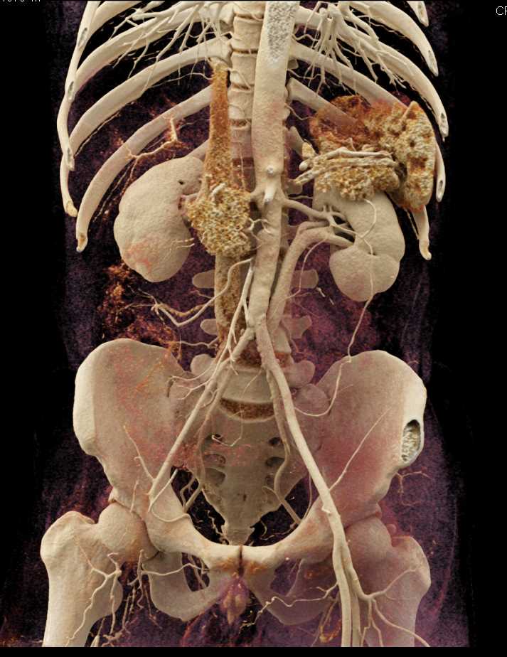 Vasculitis Involves Right Common Iliac Artery - CTisus CT Scan