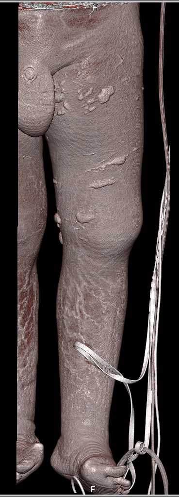 CTA Runoff with Graft in Place - CTisus CT Scan