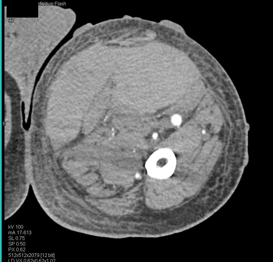 CTA Runoff with Graft in Place with Blisters in Soft Tissue with Cinematic Rendering - CTisus CT Scan