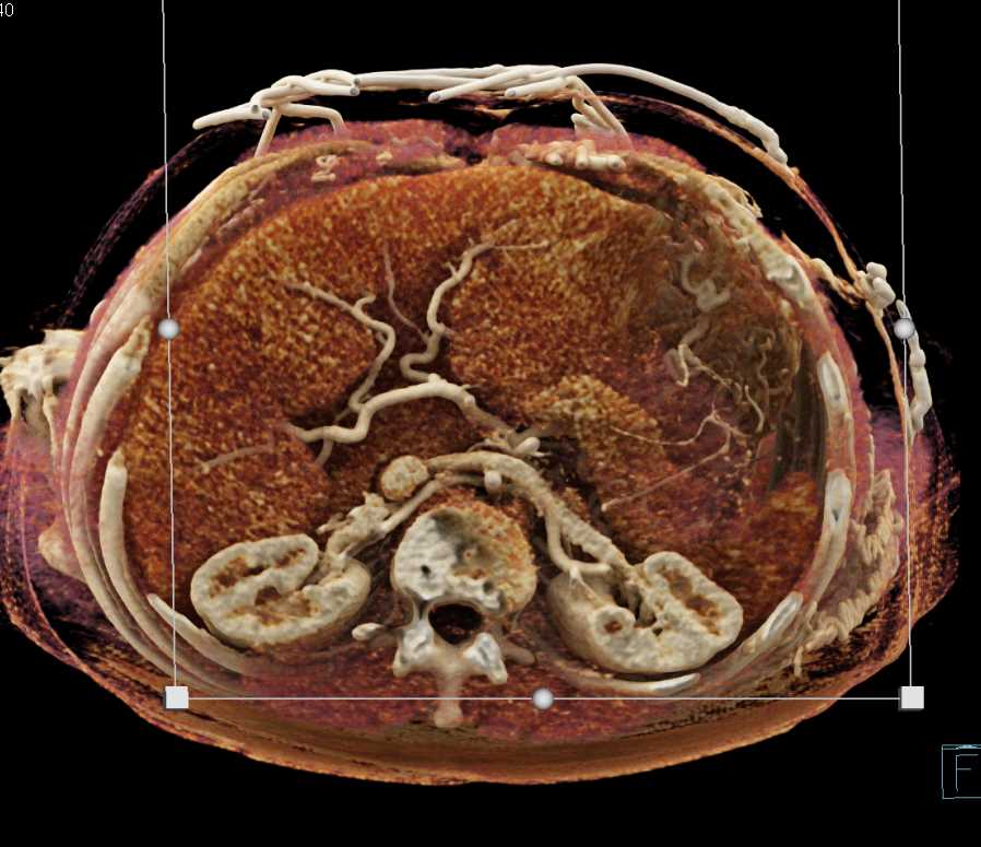Bleed from Ascending Aorta Repair - CTisus CT Scan